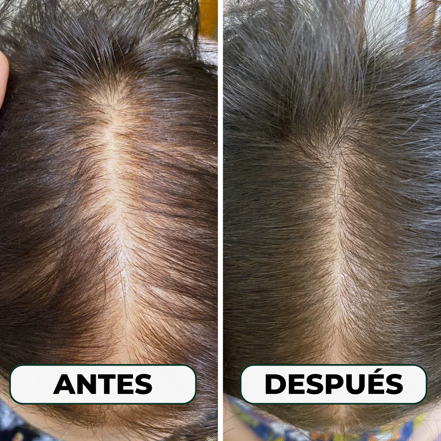 Serum Anticaída Triple Acción Skinfinity®